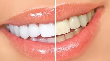 imagem com antes e depois de um clareamente