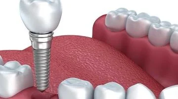 imagem mostrando uma boca com os dentes sendo um deles um implante