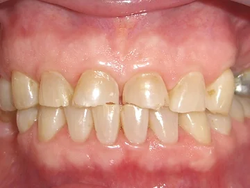 boca mostrando os dentes com consequências do bruxismo
